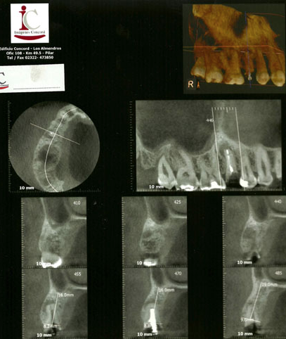 tomografia computada